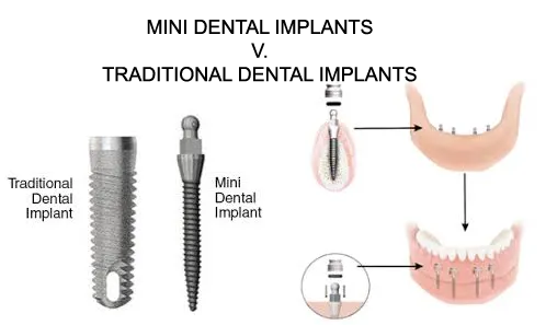 same day mini dental implants